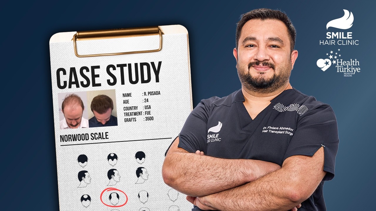 A Natural 12 Month Hair Transplant Result | 3500 Grafts Case Study