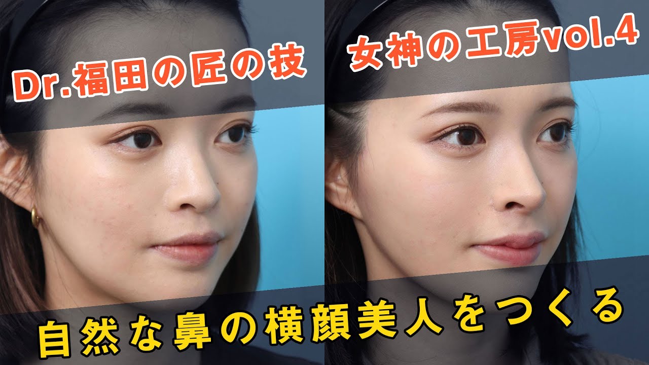 【自然な鼻整形で横顔美人をつくる】（手術シーン無し）Dr.福田の匠の技 女神の工房vol.4｜ヴェリテクリニック