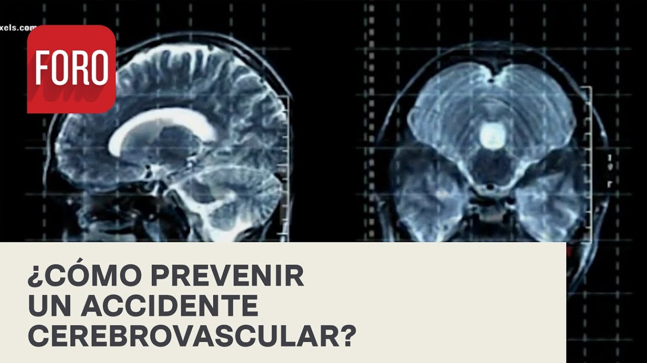 &iquest;C&oacute;mo prevenir un accidente cerebrovascular? - Por las Ma&ntilde;anas