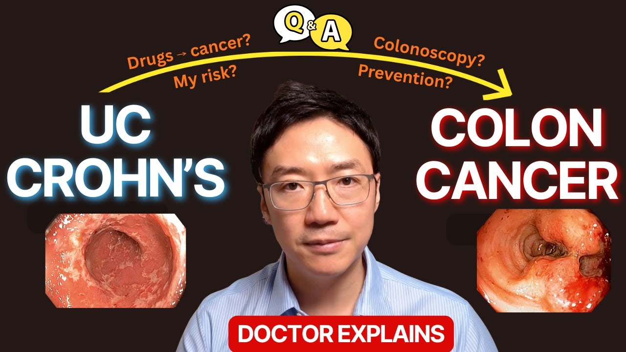 Colon Cancer in Crohn&rsquo;s & Ulcerative Colitis (IBD): Everything You Need to Know (2026)