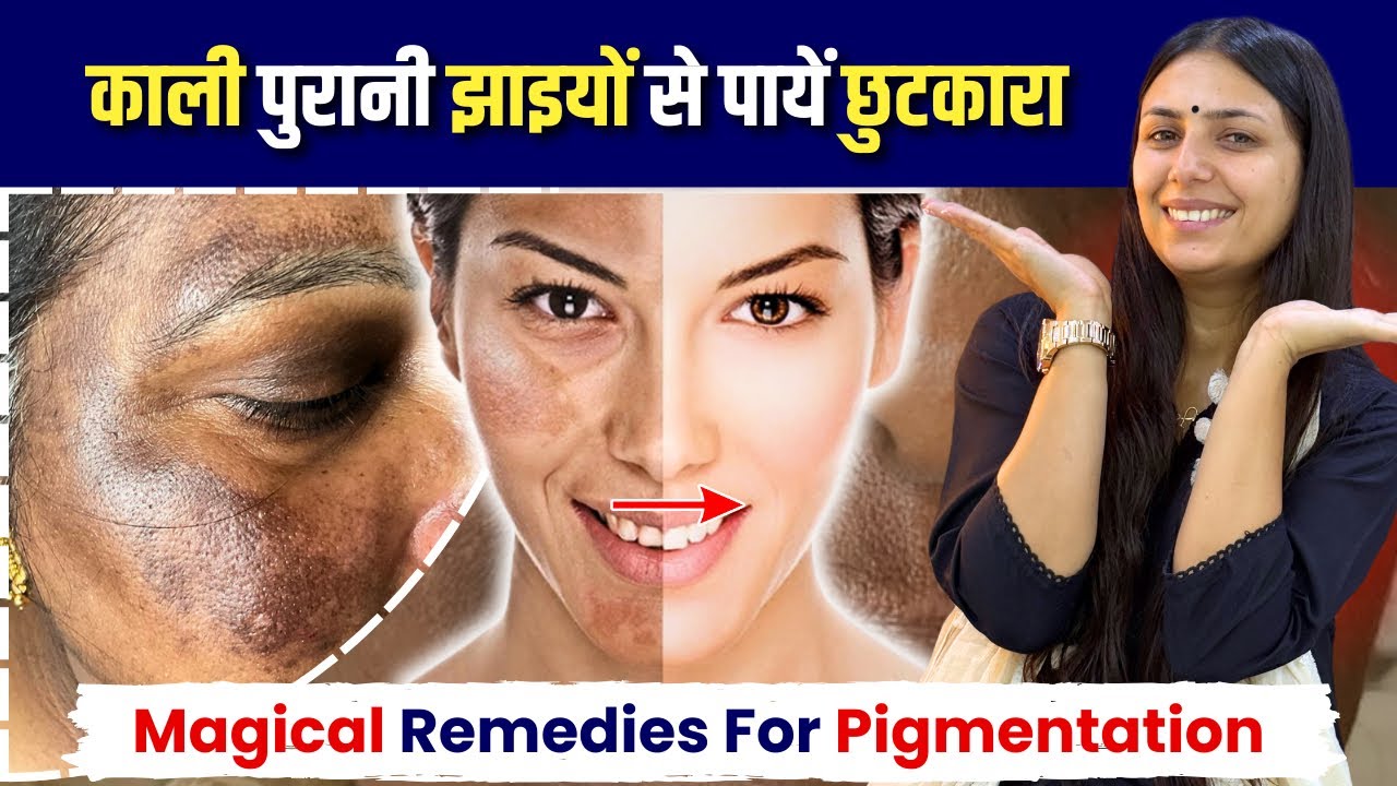 पुरानी से पुरानी झाइयां, Melasma में फर्क देखें - 7 Days Challenge | Best Remedy for Pigmentation