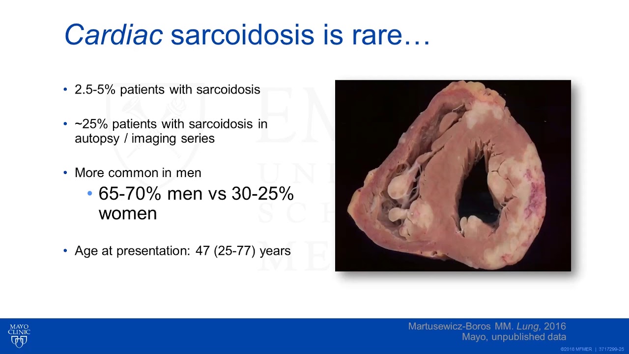 Sarcoid Heart Disease: Role of Arrhythmias and How to Treat?