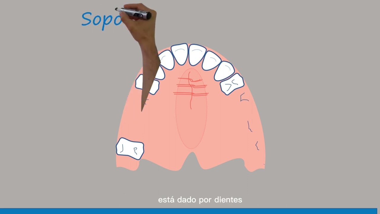 Biomecánica  de la prótesis parcial removible, la forma más fácil de entenderla