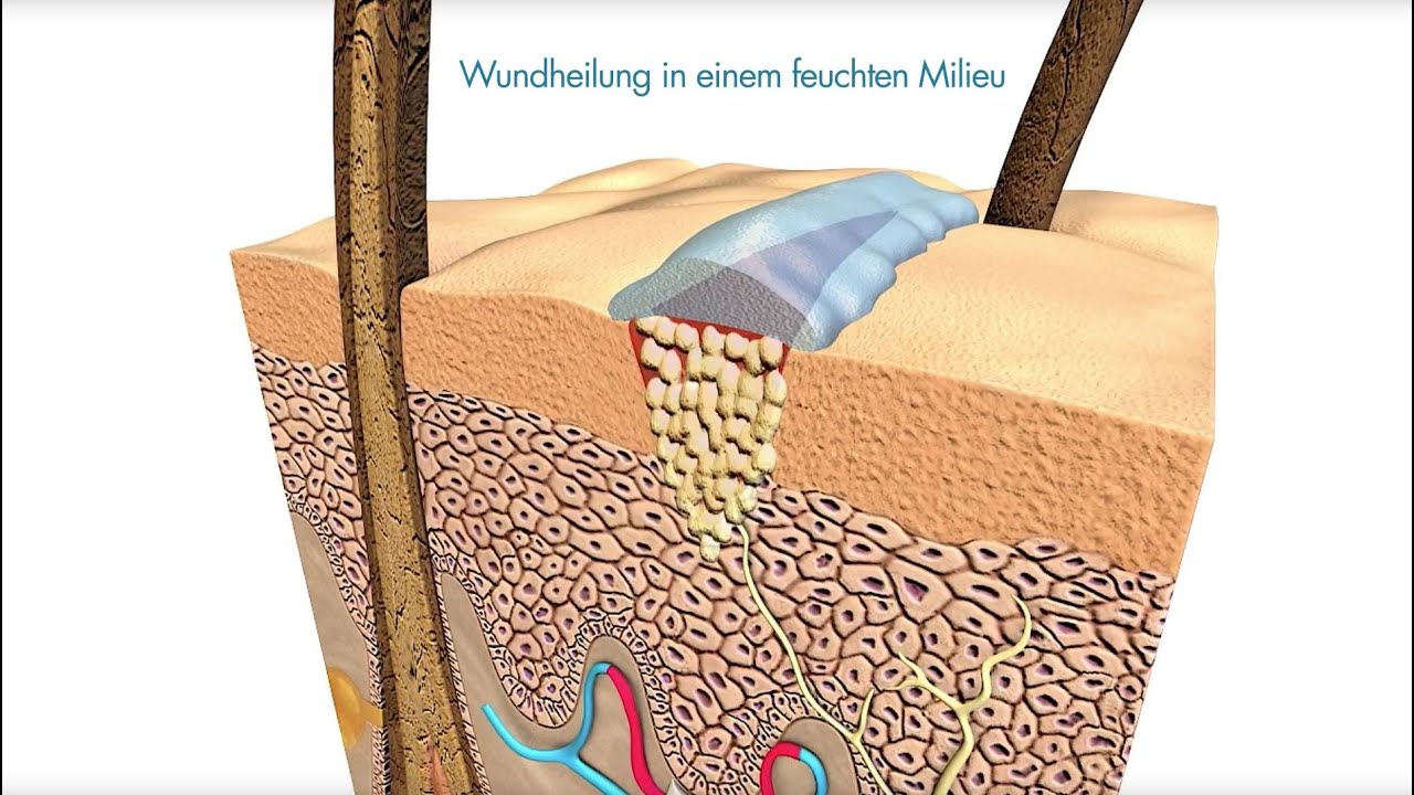 Flamigel&reg; | Optimale feuchte Wundheilung mit Flamigel