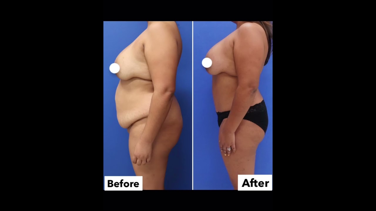 41-Year-Old Before and After Tummy Tuck With Liposuction | Avance Plastic Surgery Institute