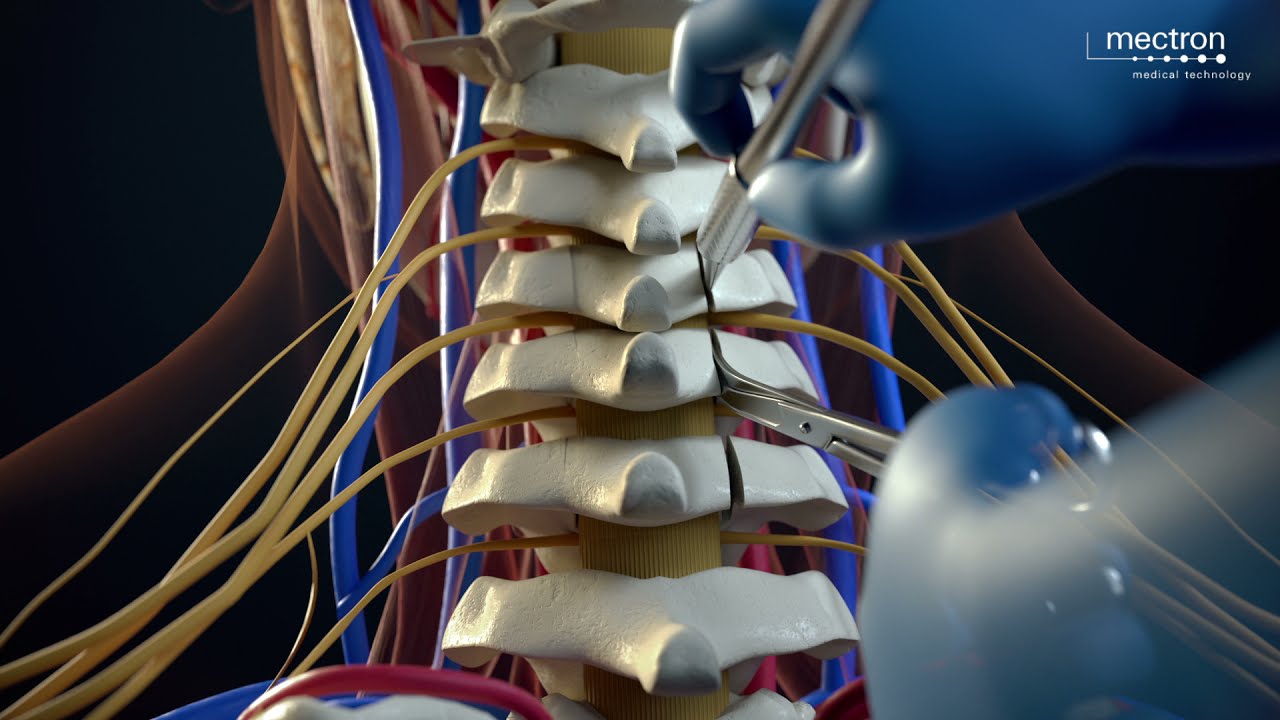 PIEZOSURGERY® | Laminotomy Procedure Animation