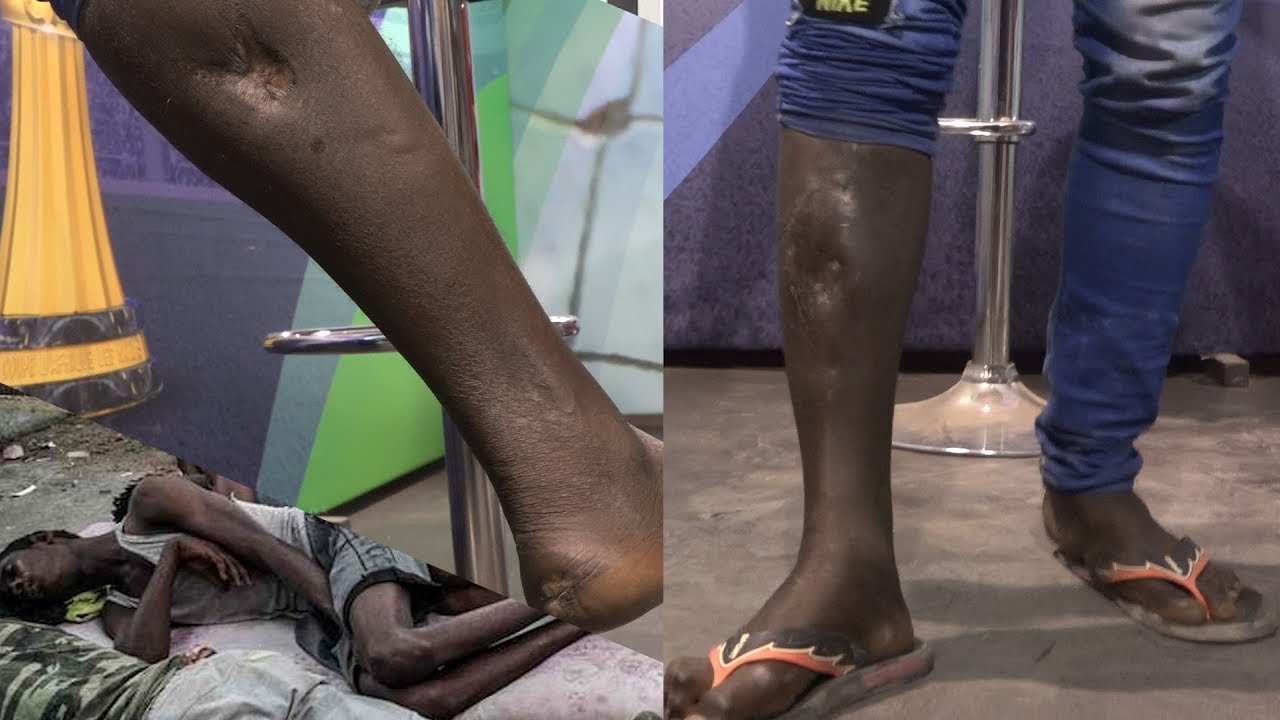 Atteint par 5 balles en Libye : Confessions d'un sénégalais en incapacité de travailler