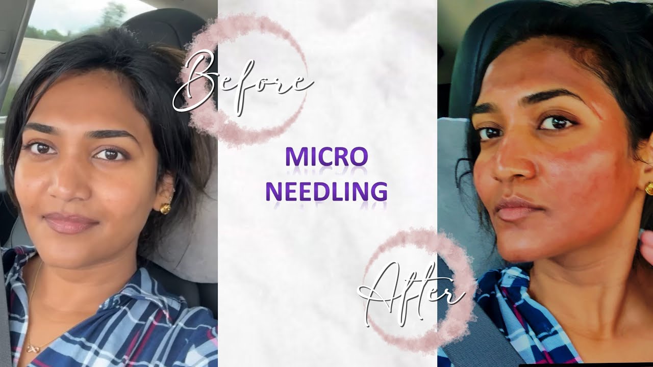 Skin Glow-Up! My Microneedling Experience & Results | Prahalicka Myakala | Vlog Canada | Chicago 
