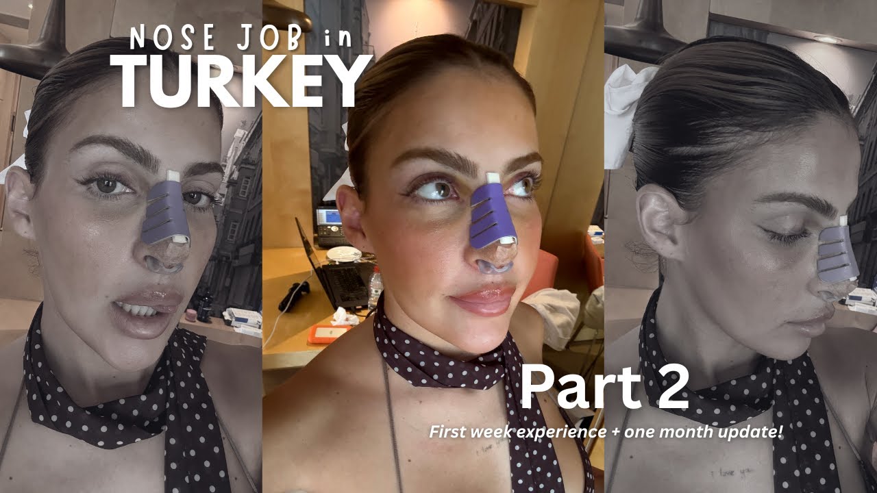 I Flew to Turkey for a Nose Job👃🇹🇷  PART 2. Honest Recovery vlog | Dr. Yusuf Orhan | Clinichub