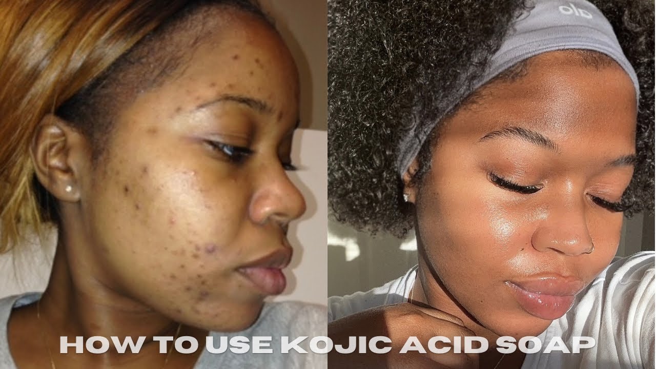 How to PROPERLY use Kojic Acid Soap for the best results