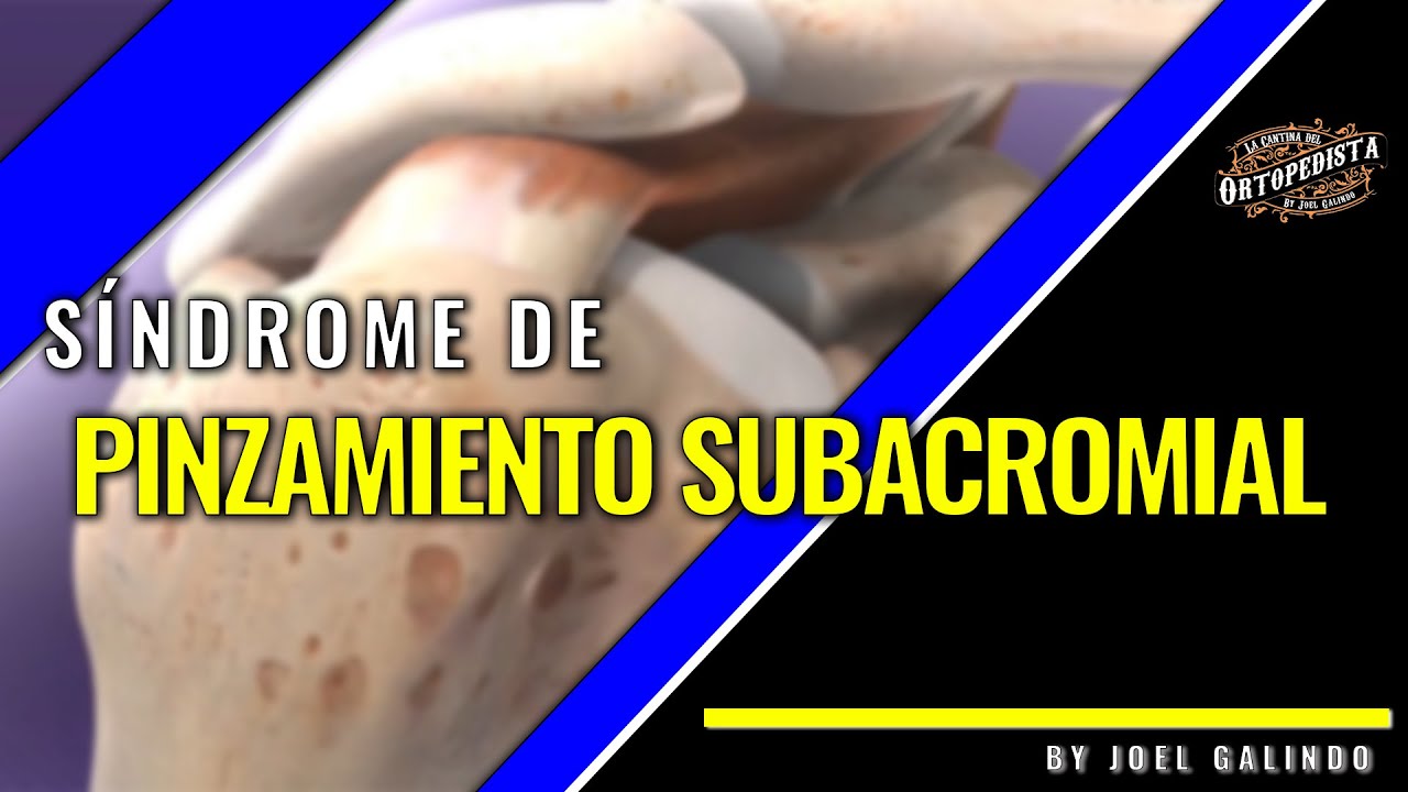 Síndrome de pinzamiento subacromial