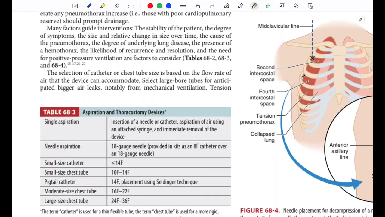 Pneumothorax 
