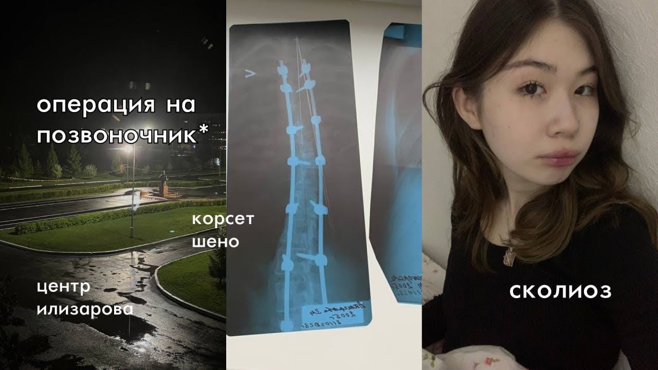 Сколиоз,операция на позвоночник и корсет шено*