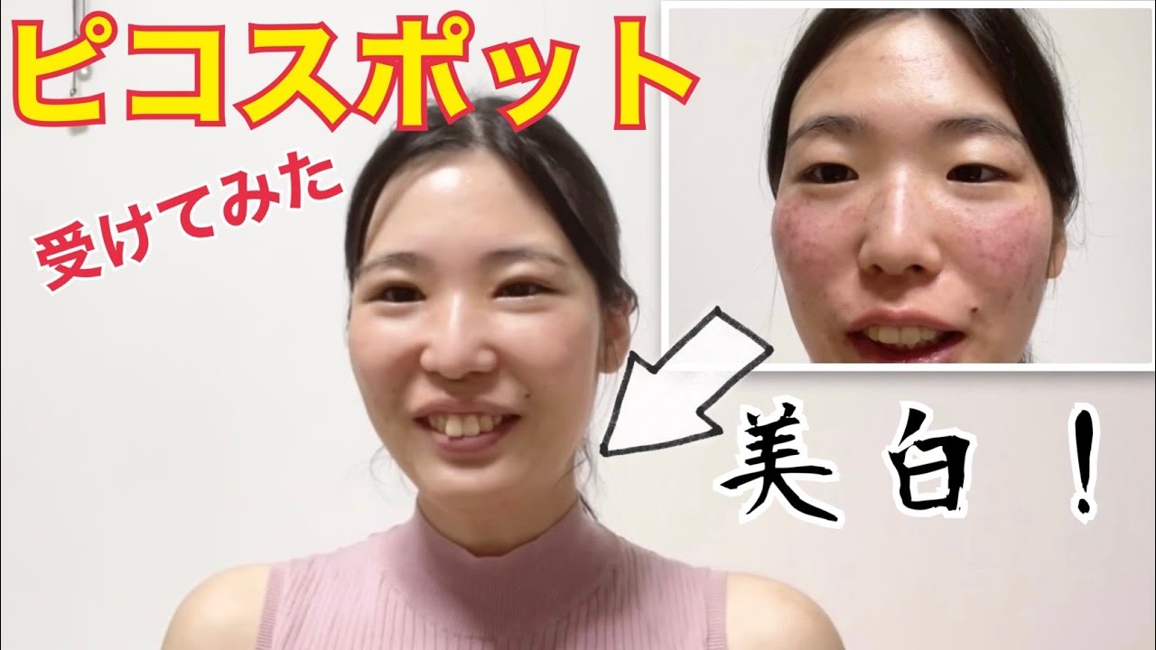 【シミ取り放題】ピコスポットの経過＆ダウンタイム記録！