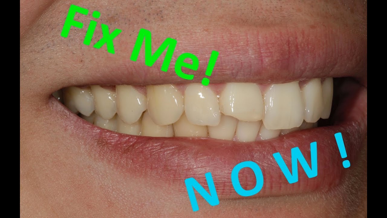 How to fix a broken front tooth the SAME DAY!