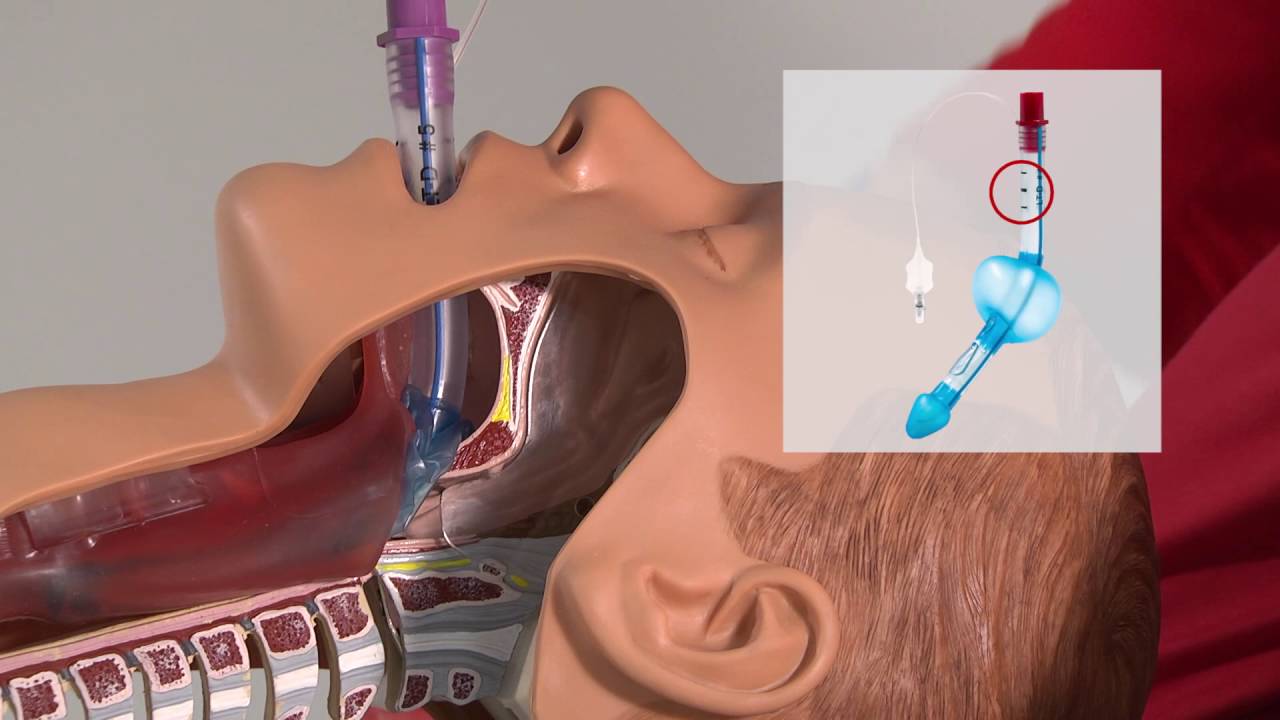 Larynxtubus Anwendung ☆ Lehrvideo für Rettungssanitäter