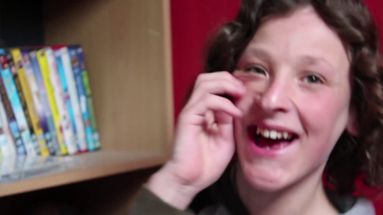 Fragile X Syndrome