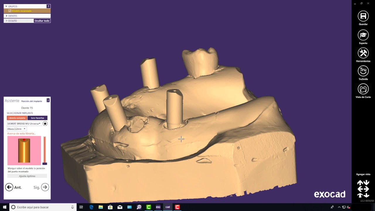Video5 CAD/CAM laboratory workflow for the PMMA SIEWERT BRIDGE for immediate loading and testing