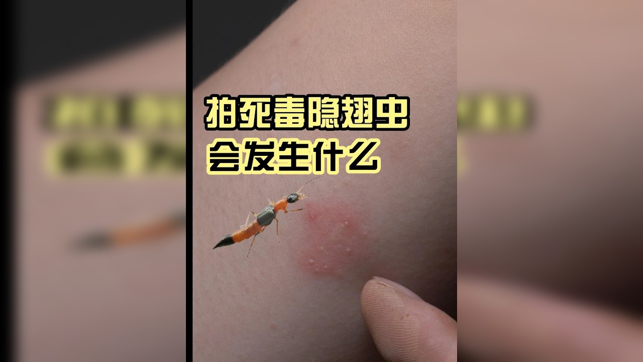 亲测：拍死毒隐翅虫会发生什么？ 一个视频带你全面了解真实的毒隐翅虫