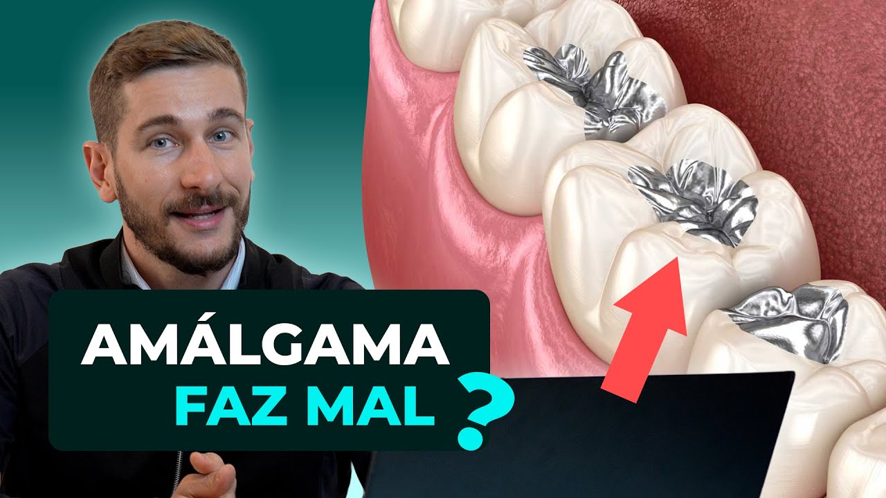 PRECISO REMOVER O AMÁLGAMA DO MEU DENTE? Dentista explica TUDO!