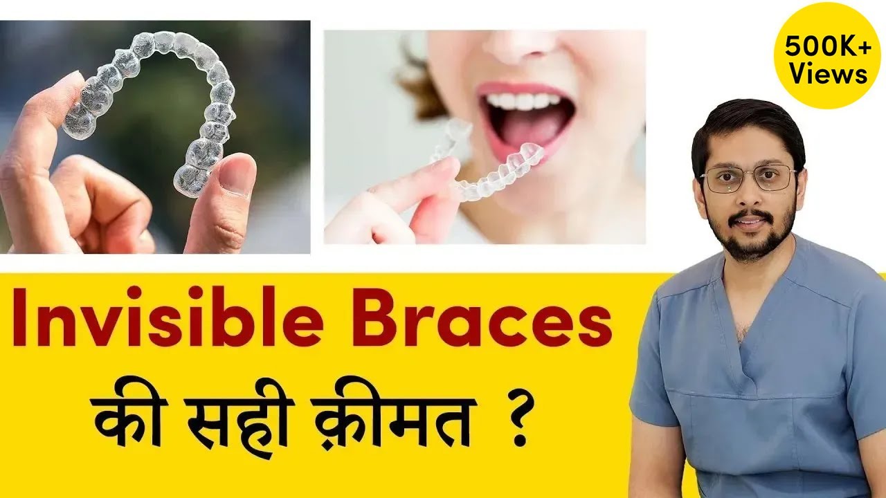 Invisible braces (dental aligners) ki sahi price | Cost of aligners in Indore ?