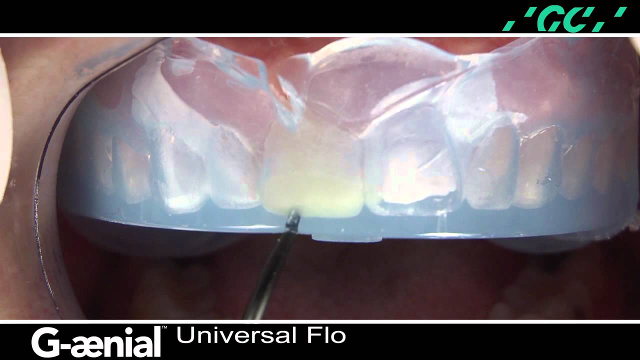Developing a Functional Composite Prototype Using G-aenial Universal Flo