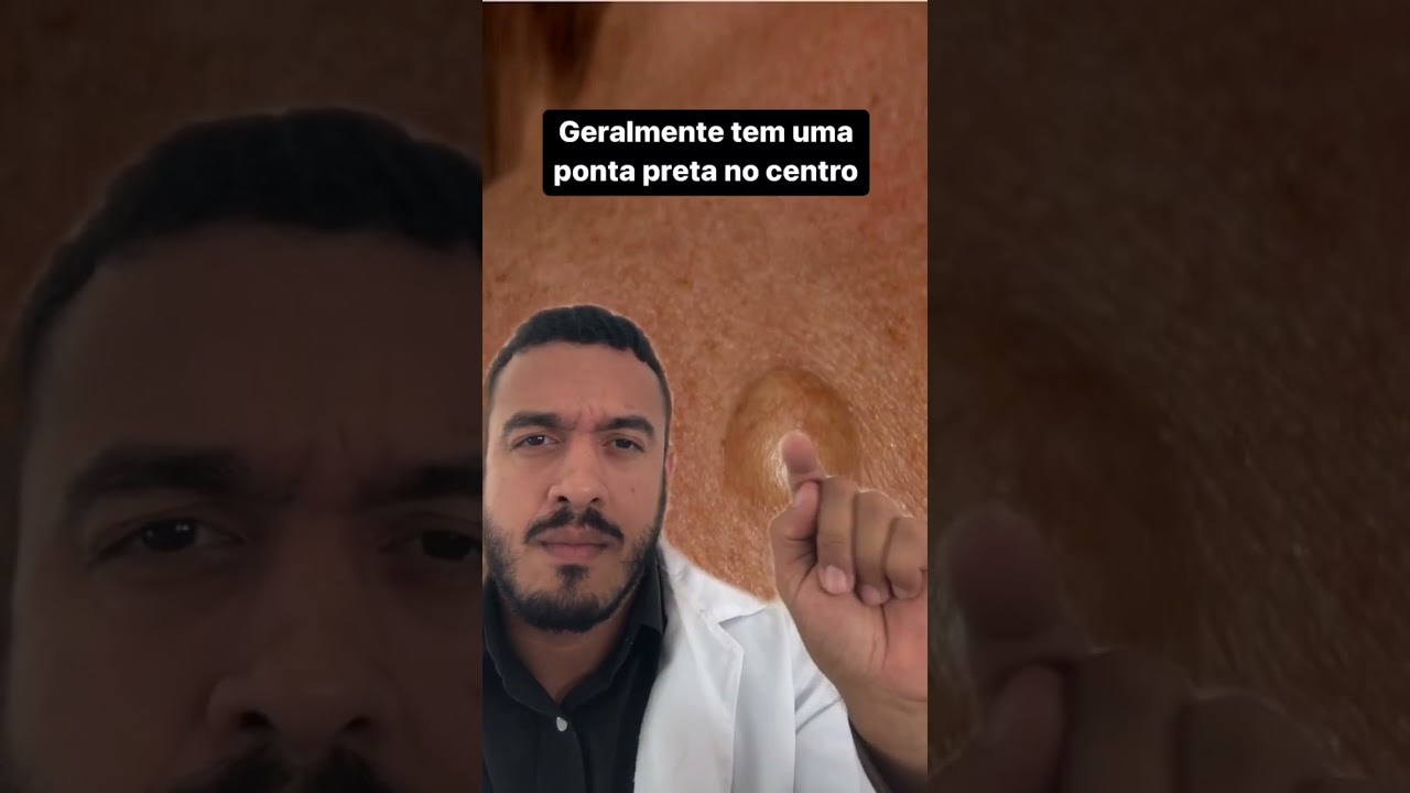 Você tem esses caroços na pele? O que pode ser? 