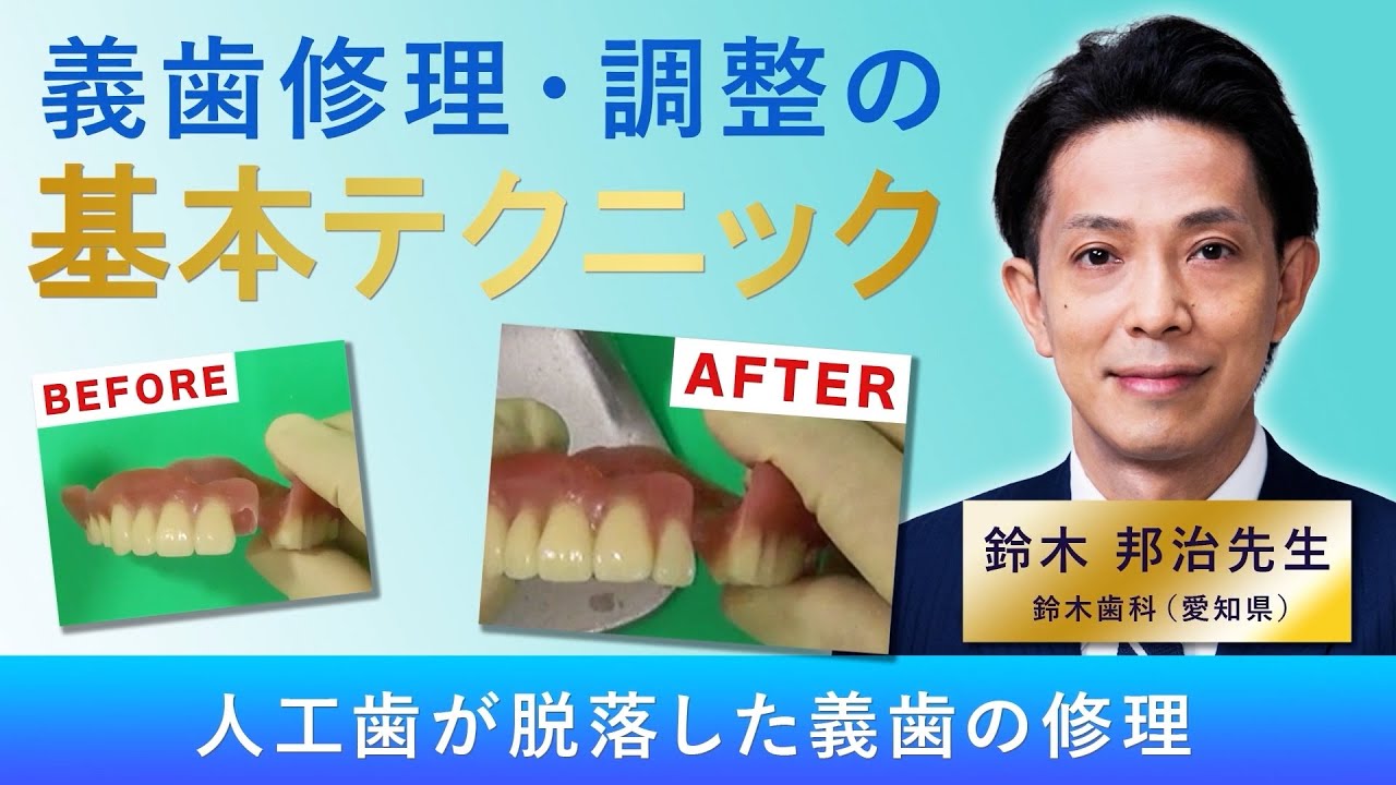 【義歯修理・調整の基本テクニック】人工歯が脱落した義歯の修理