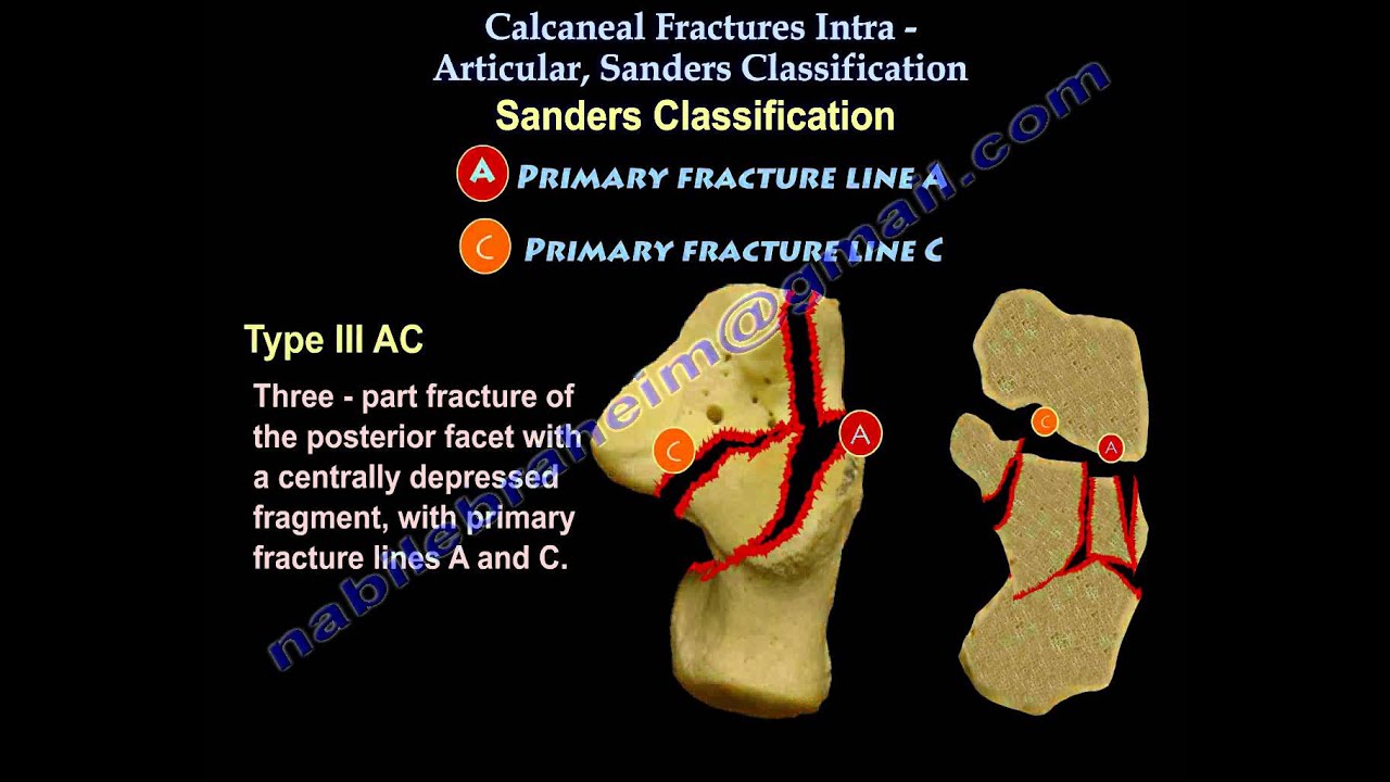 Calcaneal Intra-Articular Fractures, Sanders - Everything You Need To Know - Dr. Nabil Ebraheim
