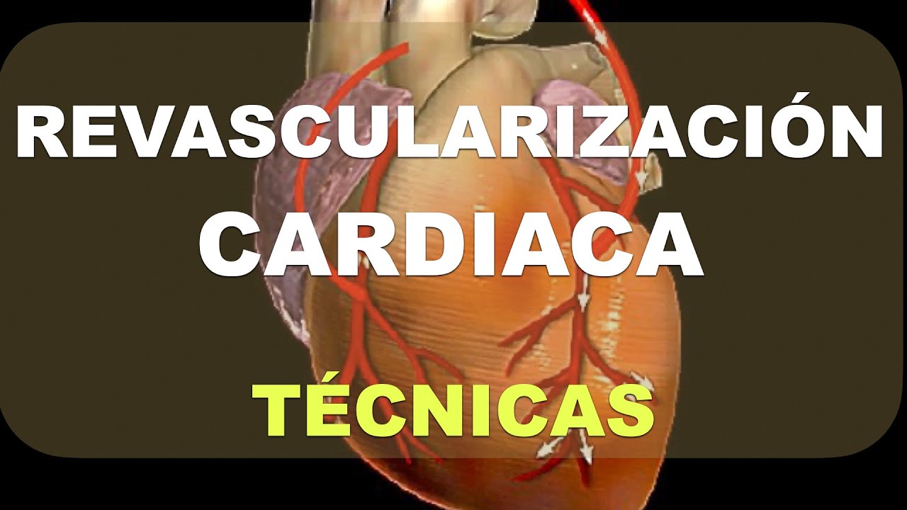 Revascularización Cardiaca. Técnicas