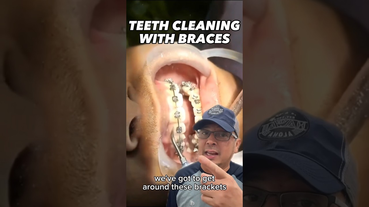 Teeth Cleaning with Braces Tip | In Office to Hands On Dental Training #shorts
