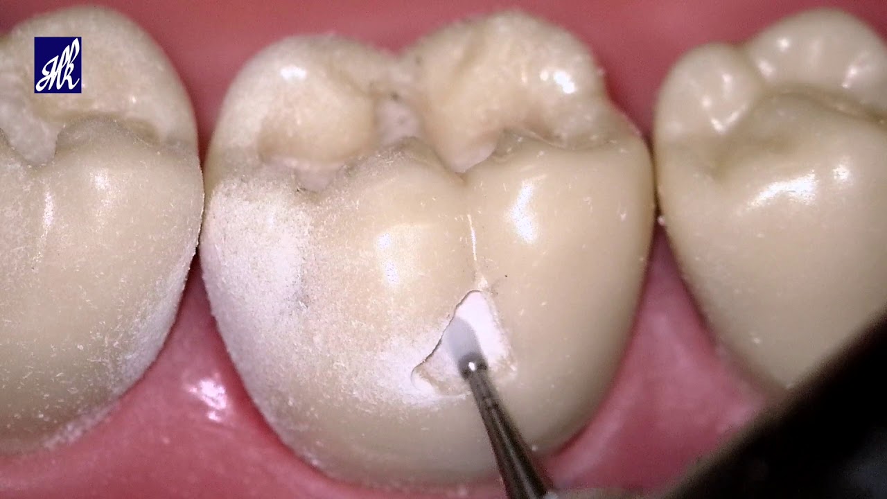 Class I Cavity preparation Buccal pits