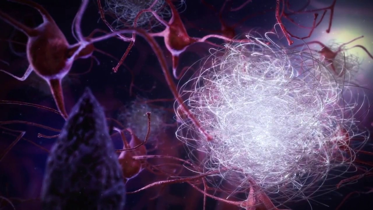 Ziekte van Alzheimer - de hersenen nader bekeken