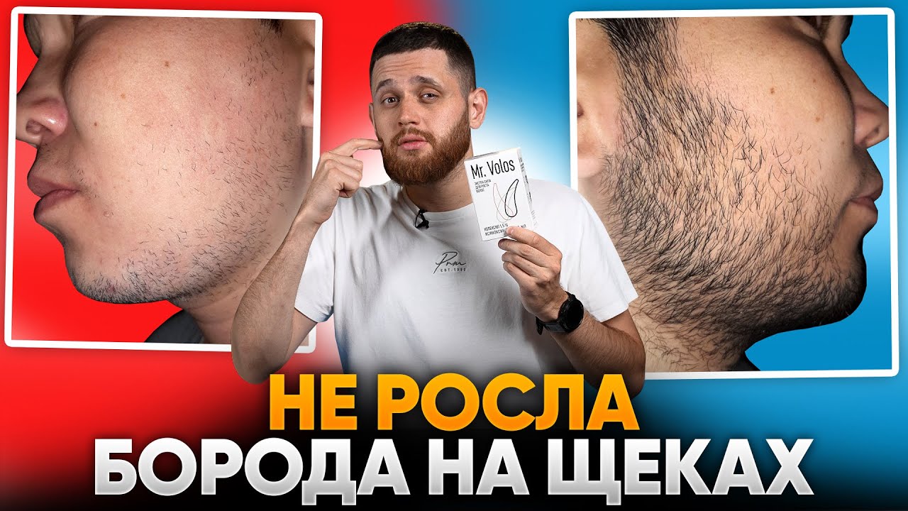За 3 месяца зарастил щёки с помощью mr.Volos / Результаты подписчиков