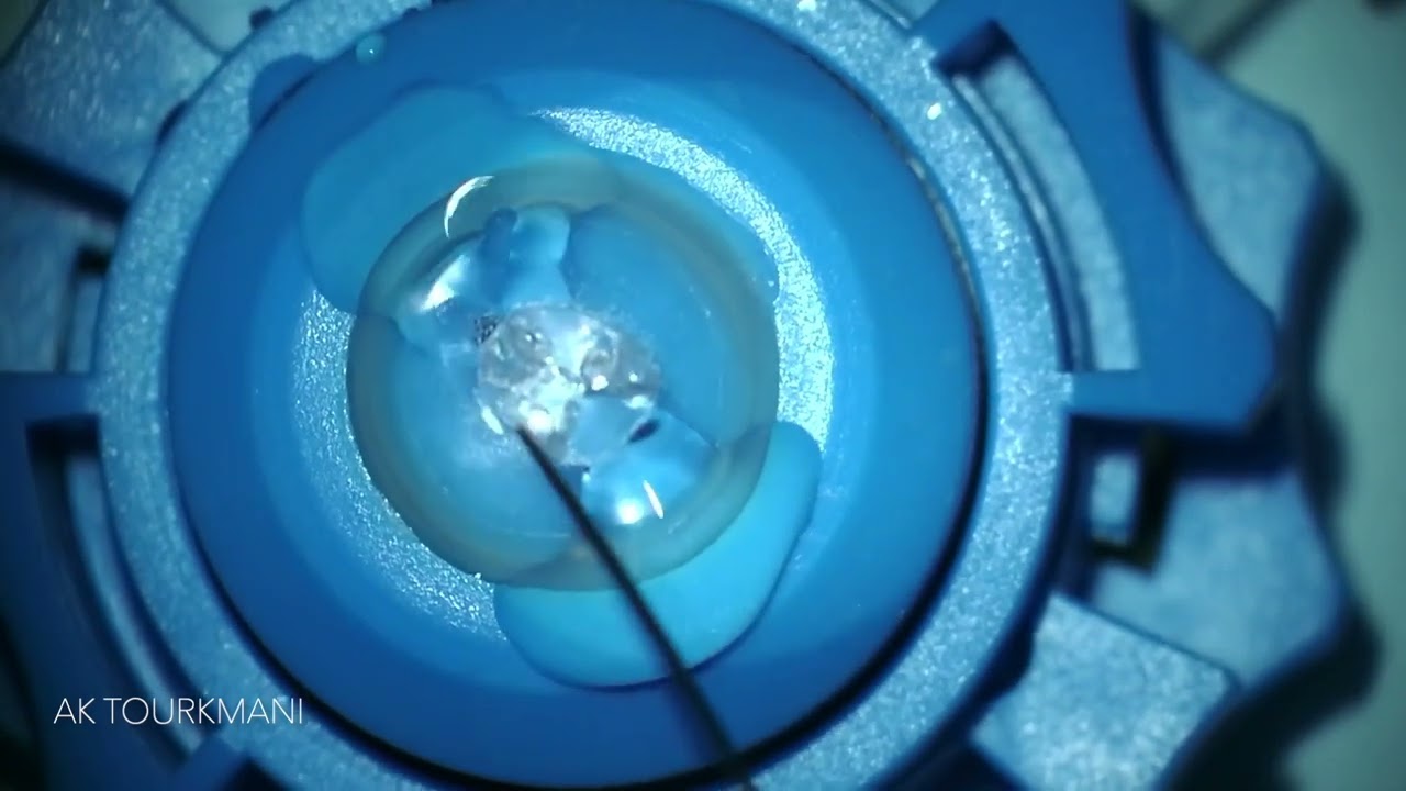 A different way to manually harvest a Bowman Layer graft