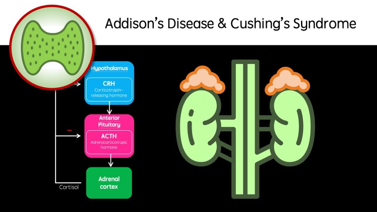 Cortisol Disorders - Addison's Disease and Cushing's Syndrome