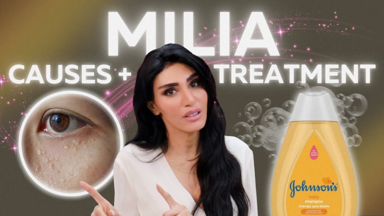 MILIA: How To FIX Them + EASY At-Home Treatments!