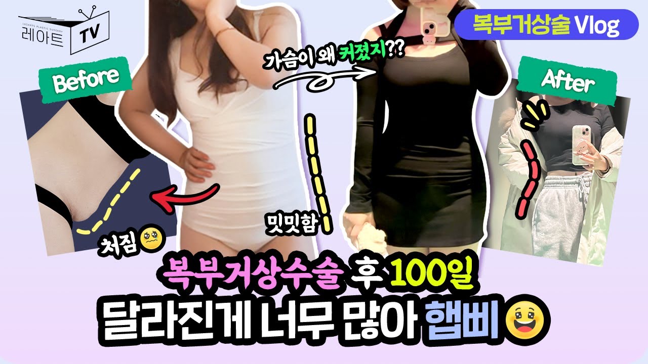 [복부거상수술 Vlog] 수술 100일 후, 왜 가슴이 커진걸까요?😮[레아트성형외과]