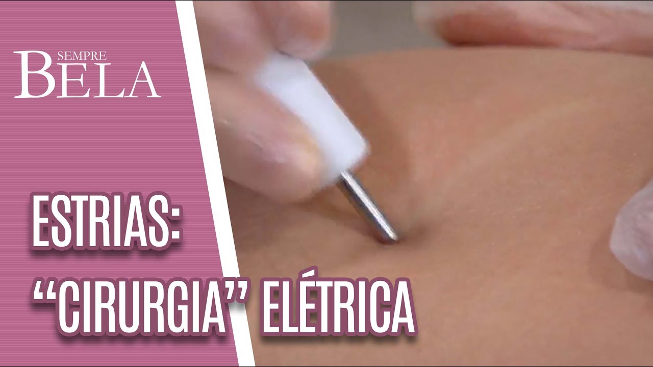 Tratamento elétrico para estrias - Sempre Bela (18/11/18)