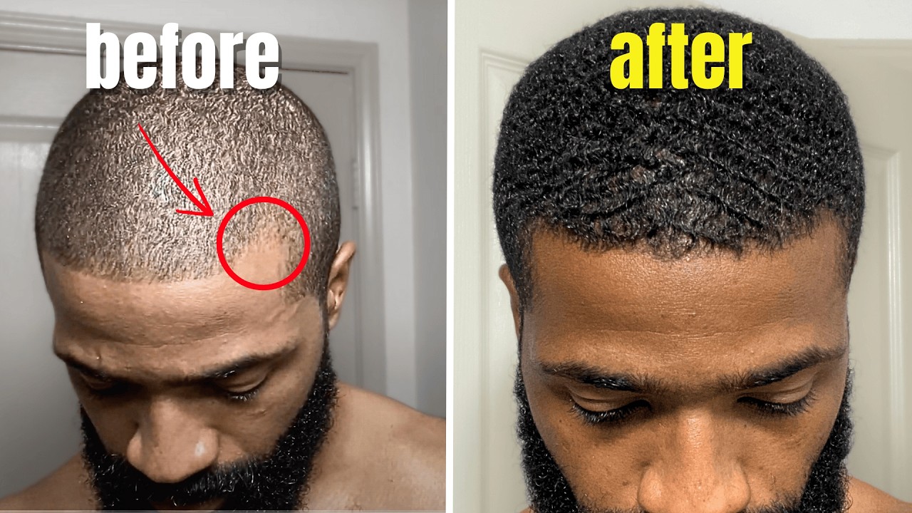 How I Got a Perfect Hairline in my 30s (5 easy habits)