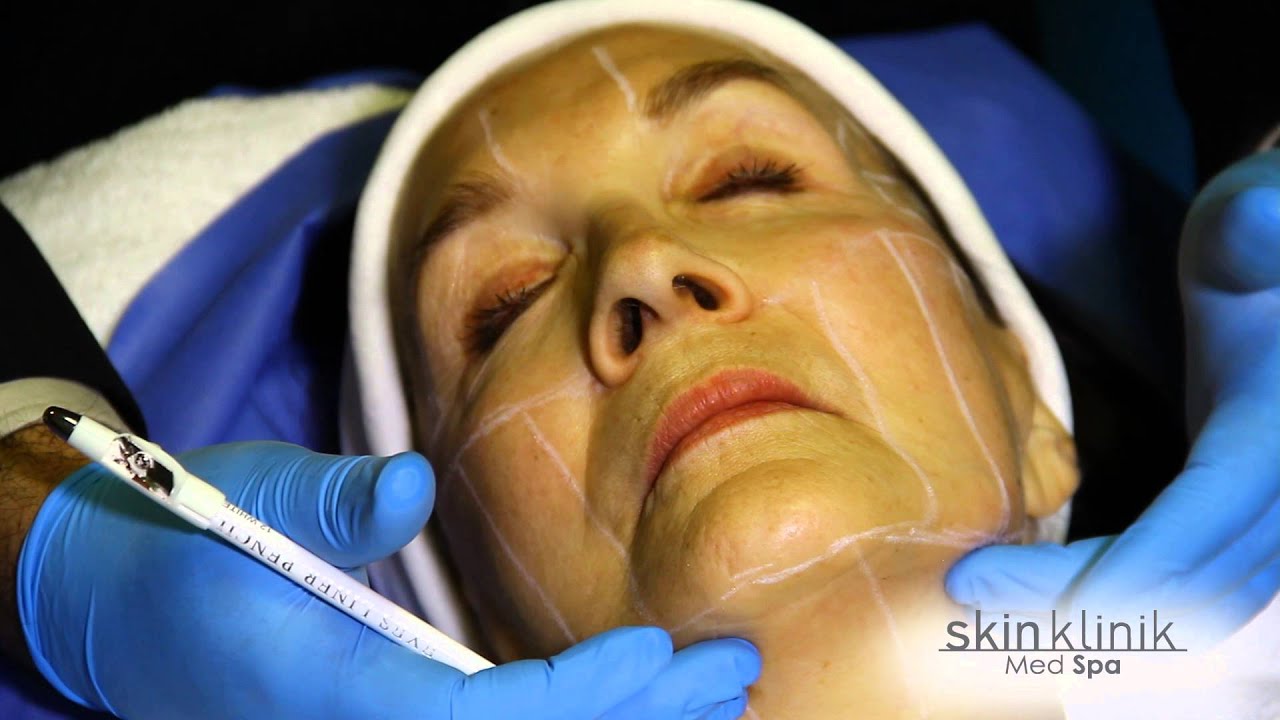 Rejuvenecimiento facial sin cirugía, sin riesgos ni tiempos de recuperación.