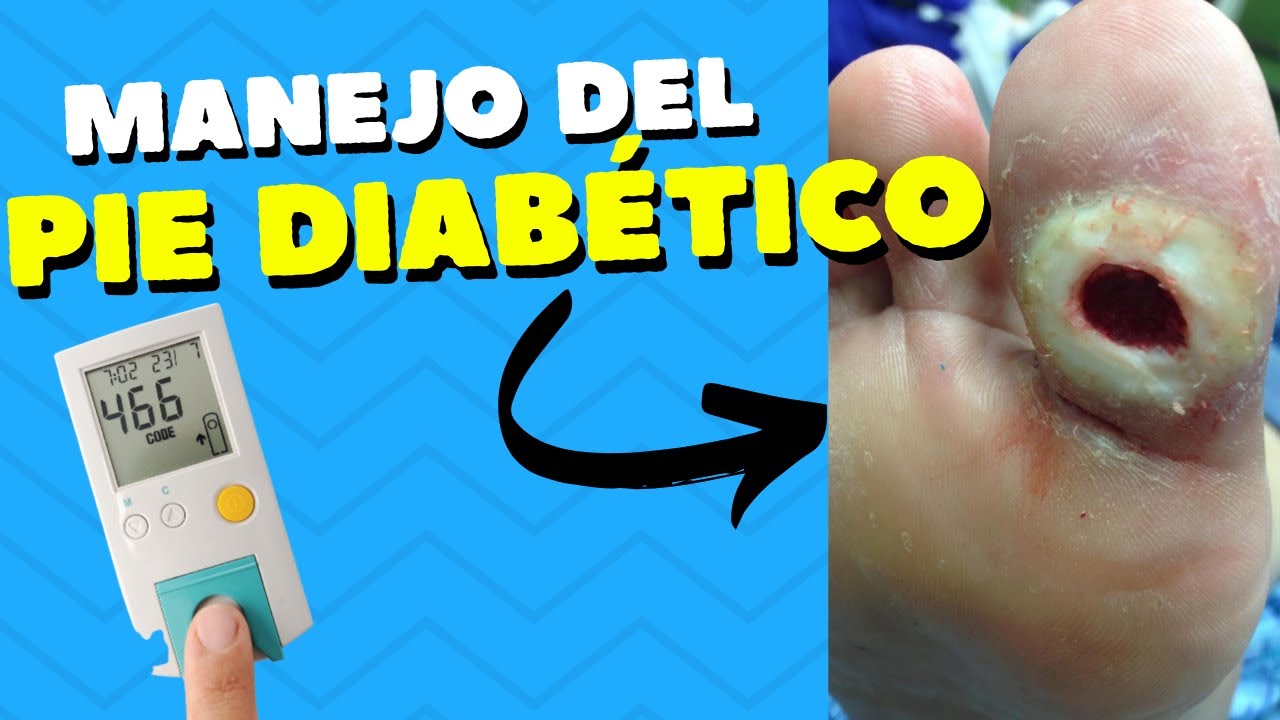 Manejo del pie diabético