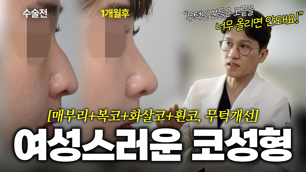 낮은 미간과 매부리+처진 코끝과 휜코교정으로 완성한 한달 차 여성스러운 무보형물 코성형 케이스, [첫단추 260213]