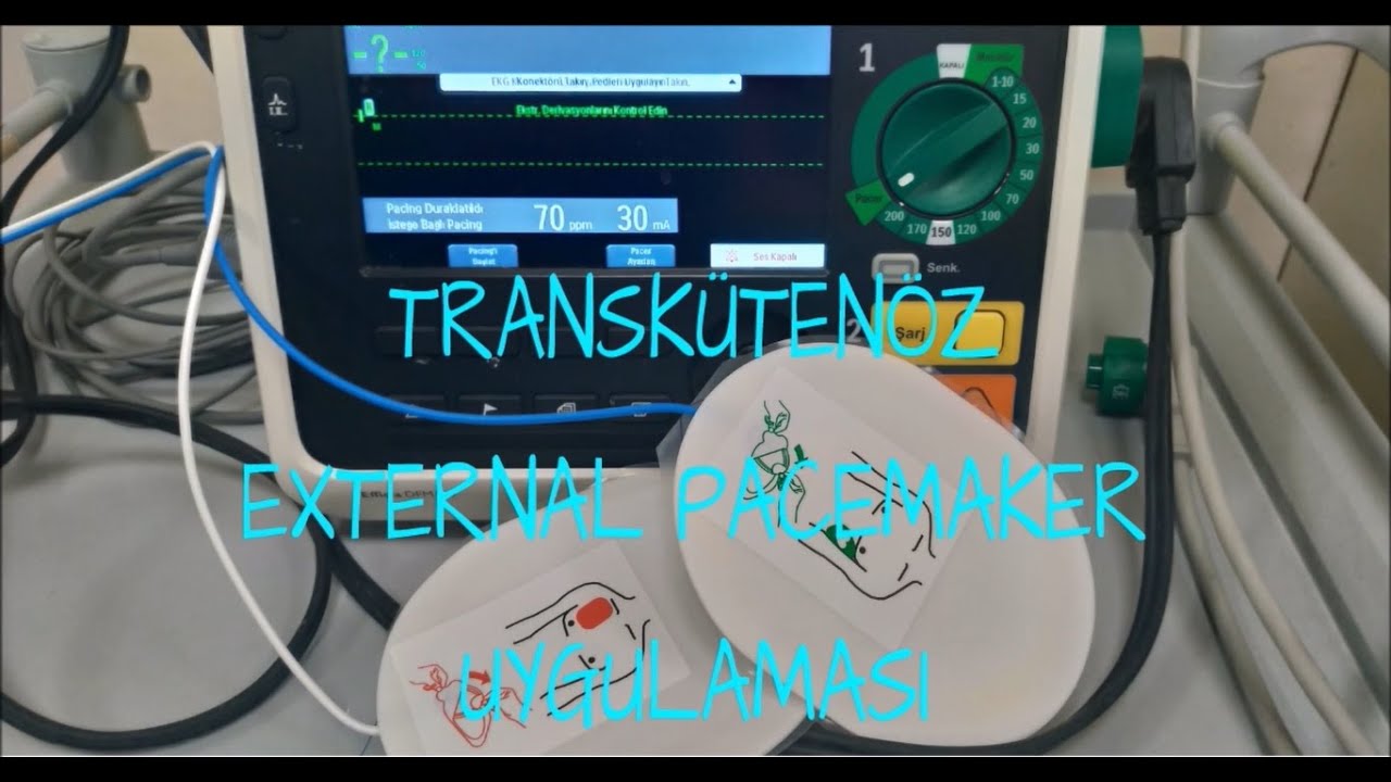 PACEMAKER UYGULAMASI