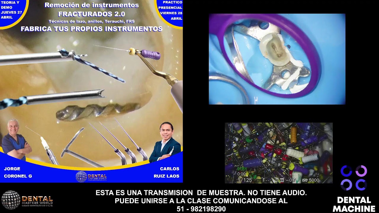 REMOCION DE INSTRUMENTOS FRACTURADOS 2.0