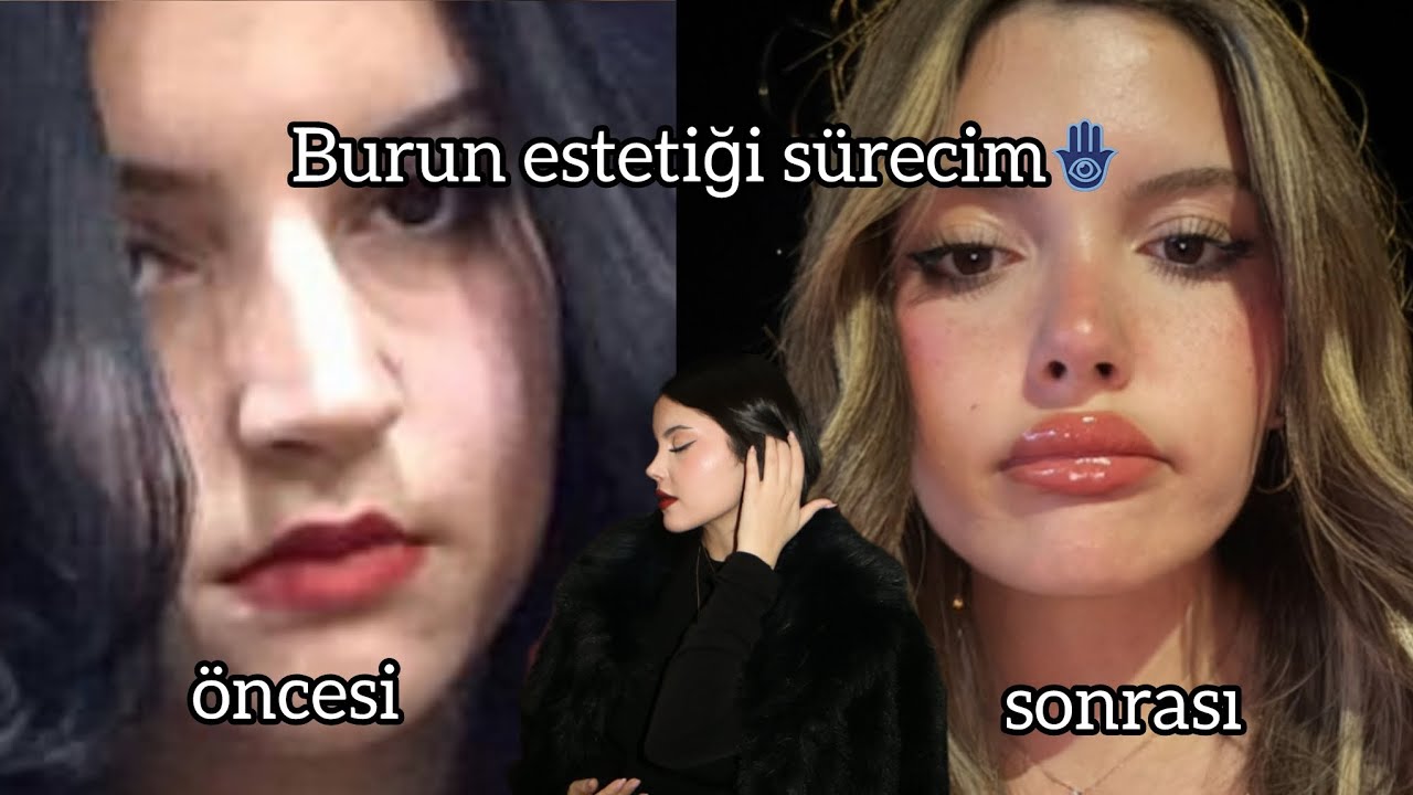 Revizyon burun estetiği🤧