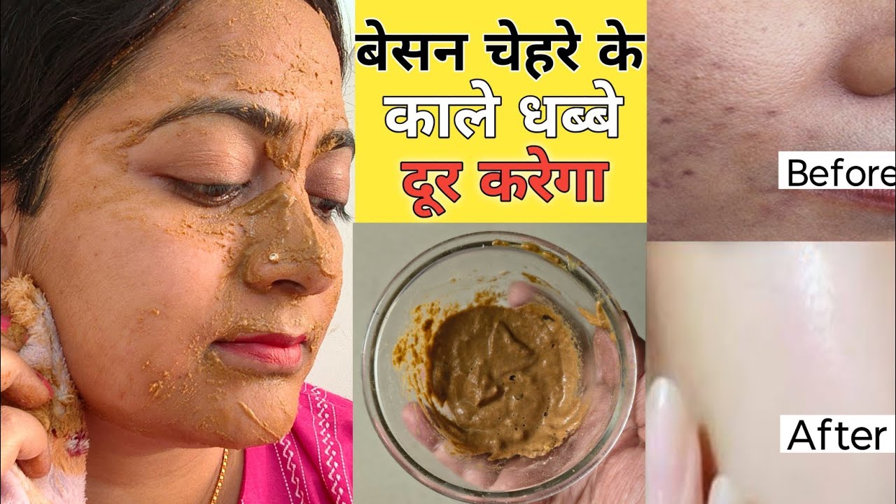  चेहरे के सारे काले दाग-धब्बे दूर करने के लिए इस तरह से लगाए बेसन आपकी त्वचा गोरी और चमकदार हो जाएगी