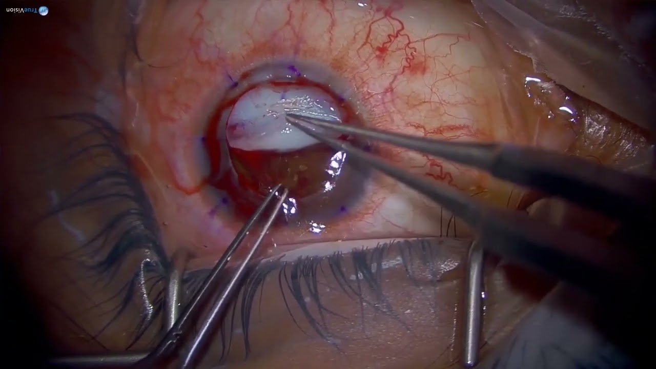 Phẫu thuật: Ghép giác mạc xuyên