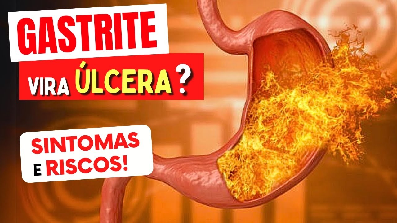 GASTRITE VIRA &Uacute;LCERA? Sintomas e Riscos que Voc&ecirc; Precisa Conhecer