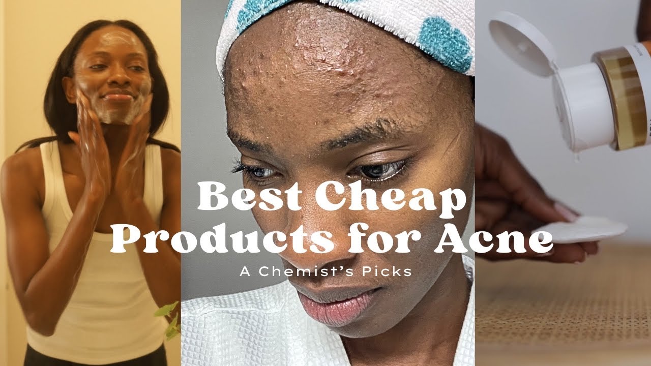 budget skincare for acne-prone skin: what actually works for acne treatment